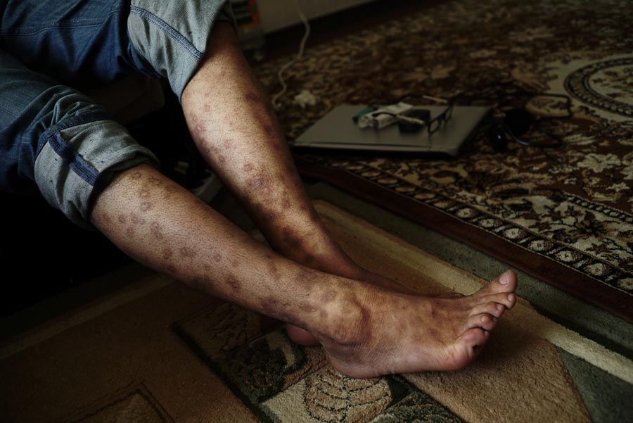 Photographed in 2014, both legs of Syrian opposition activist, aid worker and journalist Karam al-Hamad are scarred from more than 100 cigarette burns he received under torture in a military prison in Damascus for more than a year. — Photograph: Ayman Oghanna/The Washington Post.